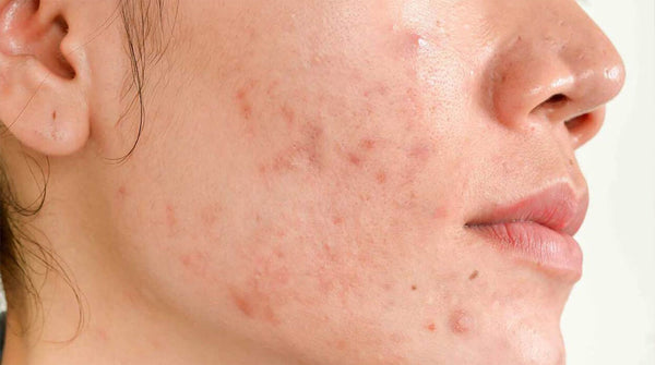 Hormonal acne : Causes and treatment
